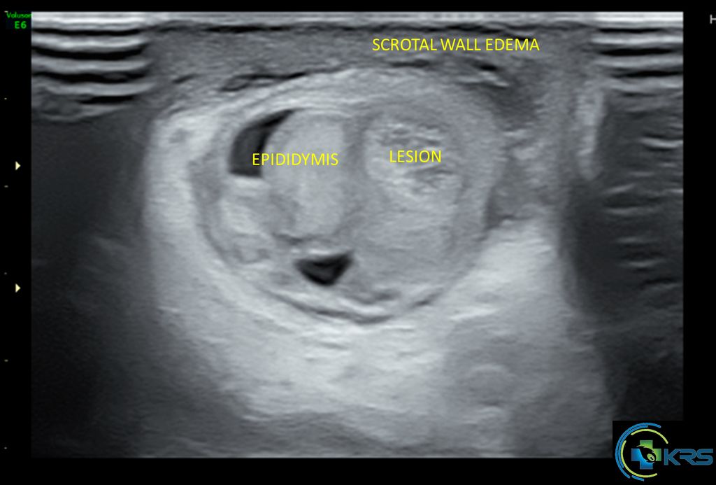 icd 10 code for left appendix testis