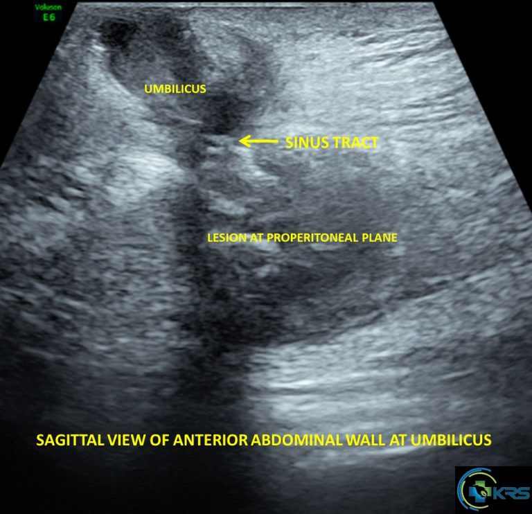 Umbilical-urachal sinus - drkalirajanscans